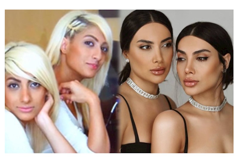 Sevil və Sevincin plastik əməliyyatdan əvvəlki halı — VİDEO