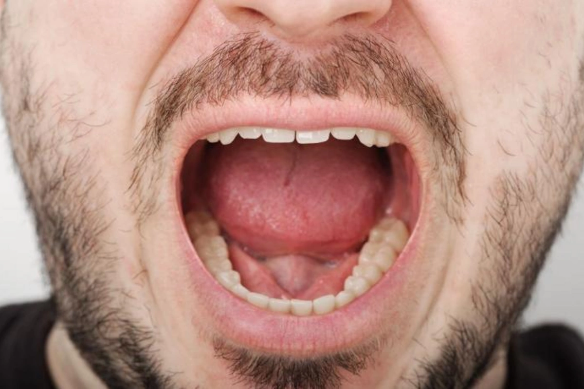 Koronavirus diş tökülməsinə səbəb olur — Araşdırma