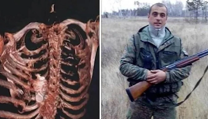 Partlamamış qumbara rus əsgərinin sinəsində ilişib qaldı — FOTO