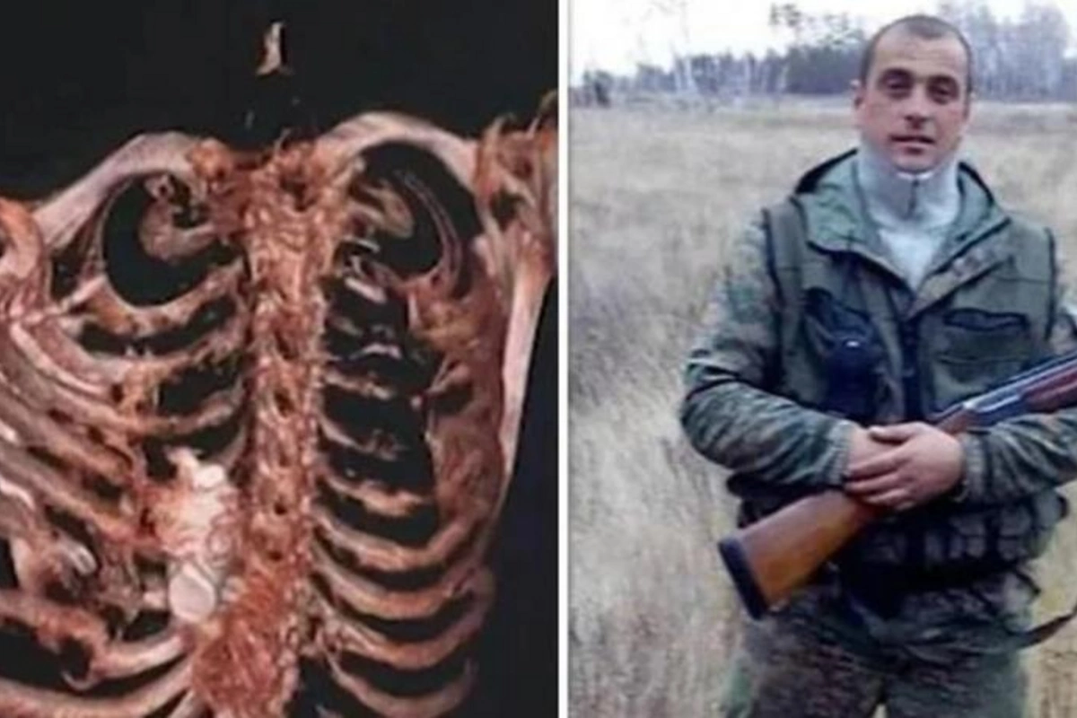 Partlamamış qumbara rus əsgərinin sinəsində ilişib qaldı — FOTO