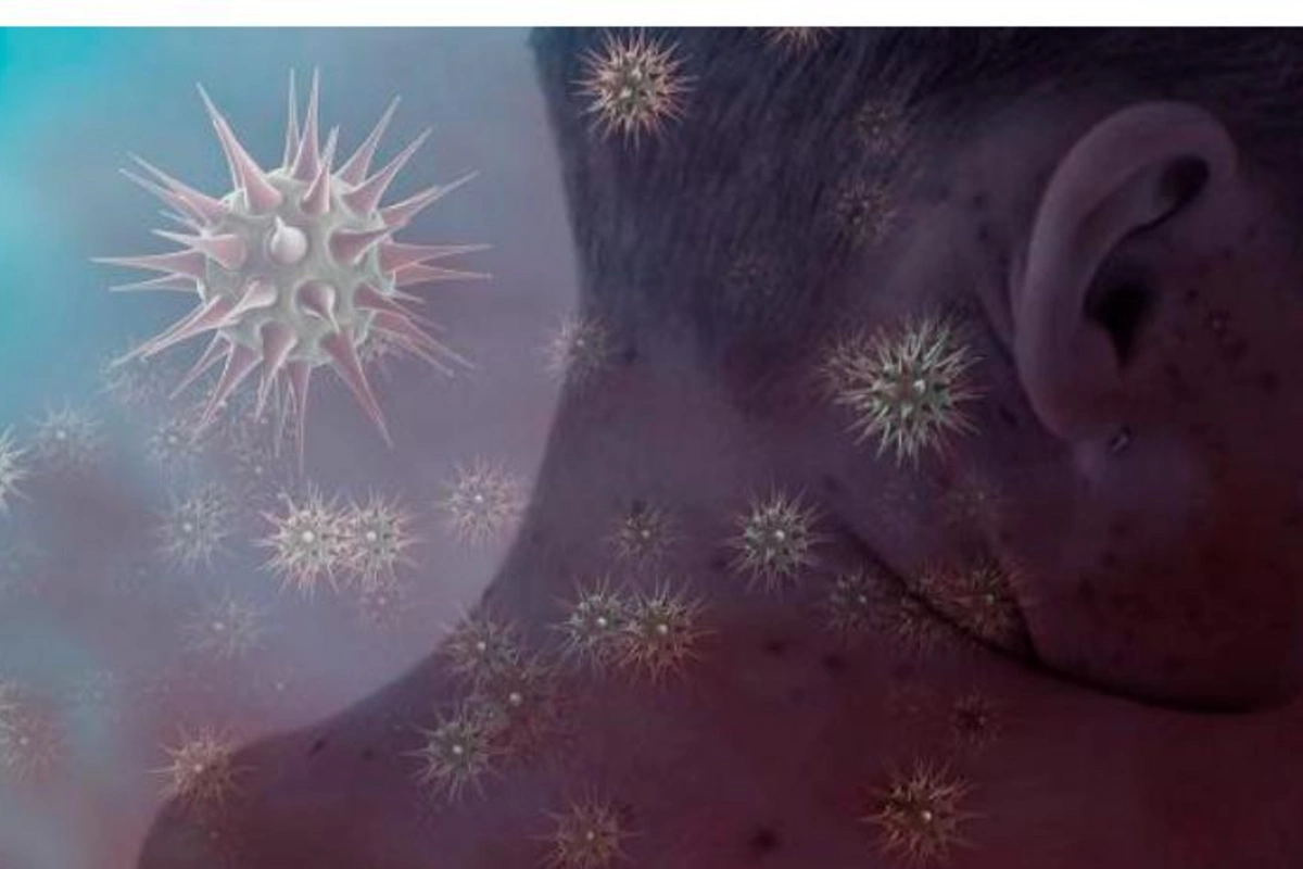 COVİD-19-dan sonra yeni virus yayılır — 3 nəfərdən birini öldürür