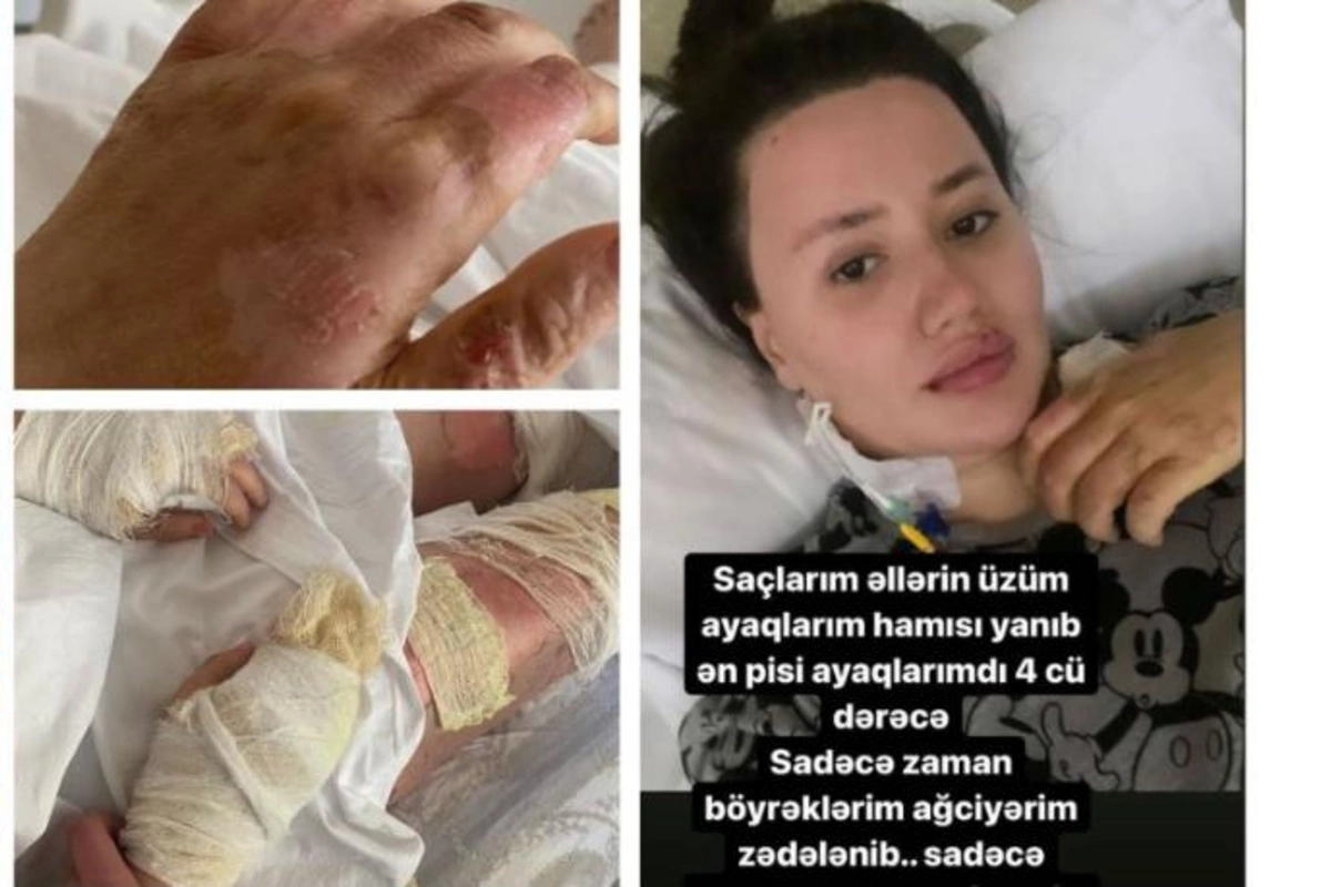Klubdakı partlayışda yanan Aysel Şükürovadan DƏHŞƏTLİ SÖZLƏR: qışqırıqlar, yanmağım...