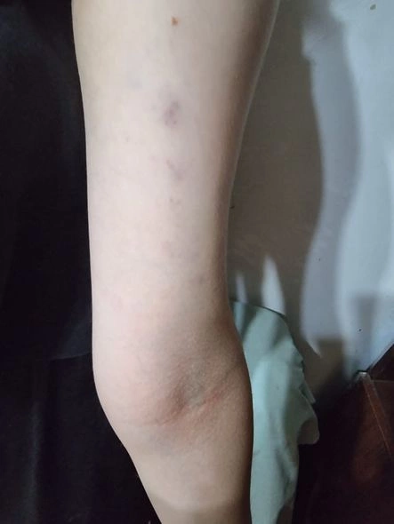 Lənkəranda icra başçısının müavini yeniyetmə qızı vəhşicəsinə döyüb — İDDİA (FOTO)