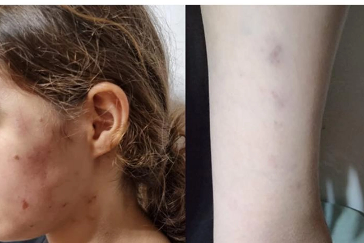 Lənkəranda icra başçısının müavini yeniyetmə qızı vəhşicəsinə döyüb — İDDİA (FOTO)