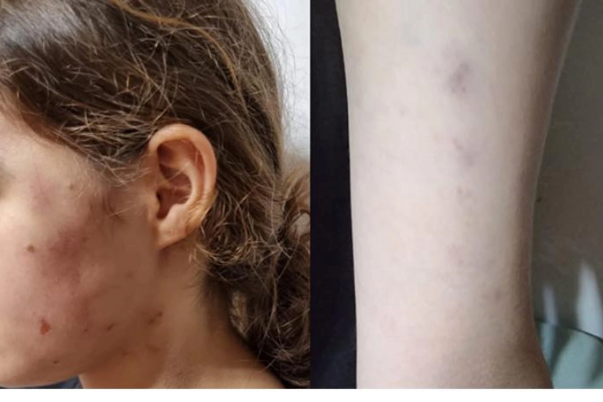 Məktəbli qızın döyülməsi iddiası ilə bağlı RƏSMİ AÇIQLAMA