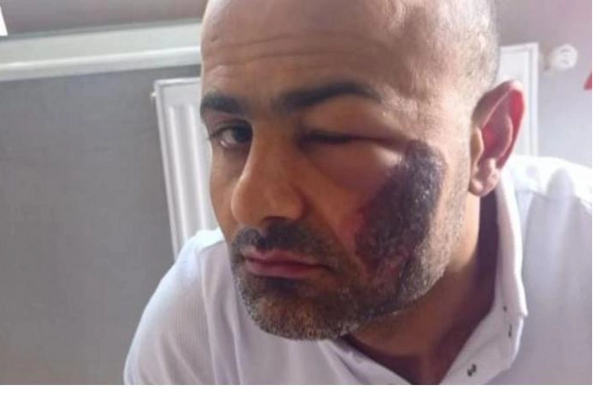 Lazer epilyasiyası etdirən kişinin başına iş gəldi