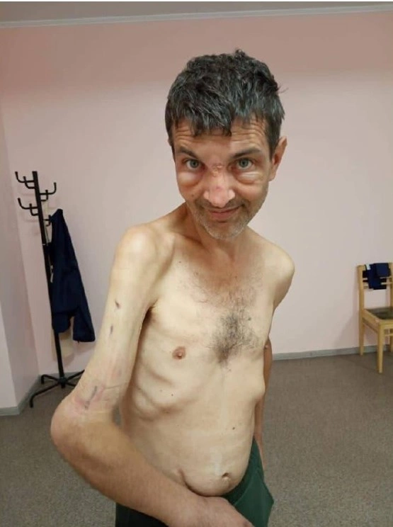 4 ay Rusiya əsirliyi “Azov döyüşçüsü”nü tanınmaz hala saldı — FOTO