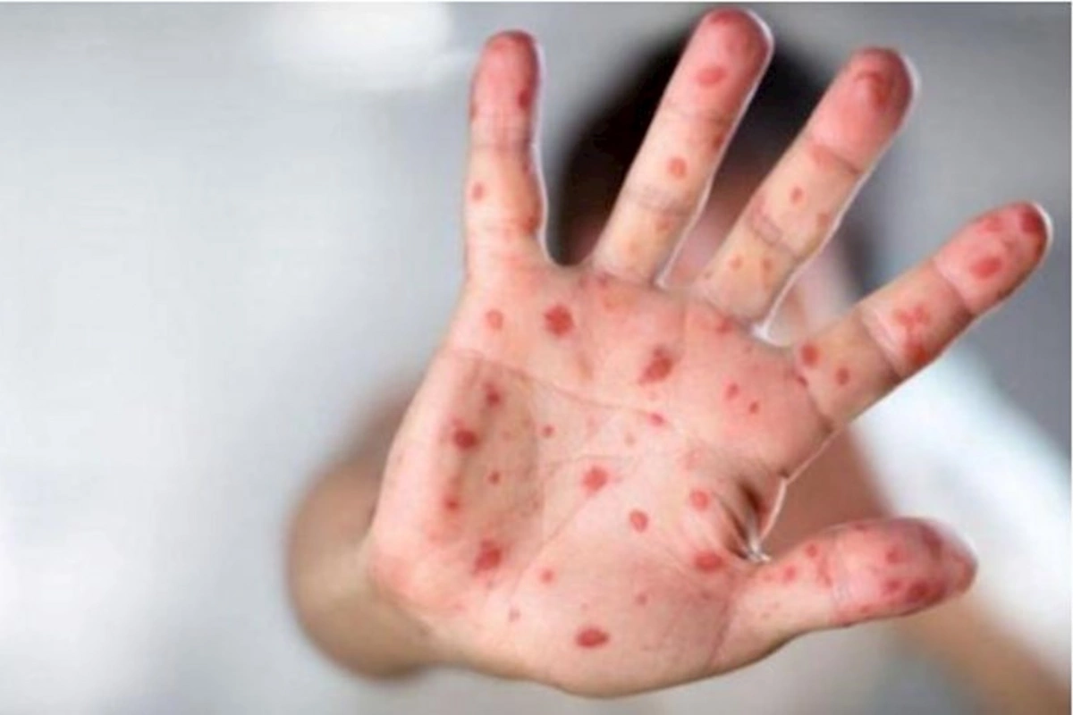 Nazirlik qızılcaya yoluxma ilə bağlı epidemioloji vəziyyəti AÇIQLADI