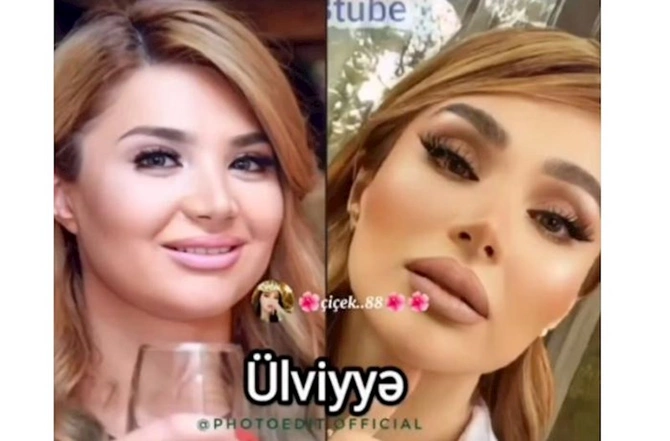 Məşhurlarımızın əməliyyatdan əvvəl və sonrakı HALLARI — FOTOLAR Məşhurlarımızın əməliyyatdan əvvəl və sonrakı HALLARI — FOTOLAR