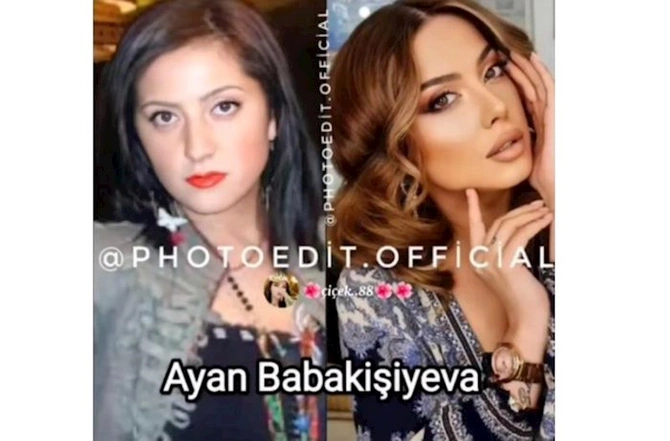 Məşhurlarımızın əməliyyatdan əvvəl və sonrakı HALLARI — FOTOLAR Məşhurlarımızın əməliyyatdan əvvəl və sonrakı HALLARI — FOTOLAR