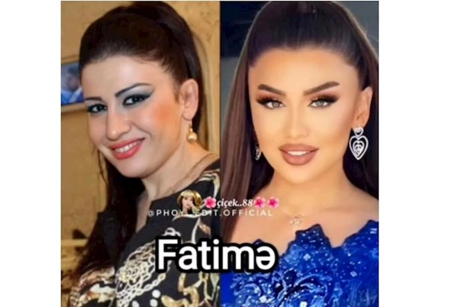 Məşhurlarımızın əməliyyatdan əvvəl və sonrakı HALLARI — FOTOLAR Məşhurlarımızın əməliyyatdan əvvəl və sonrakı HALLARI — FOTOLAR