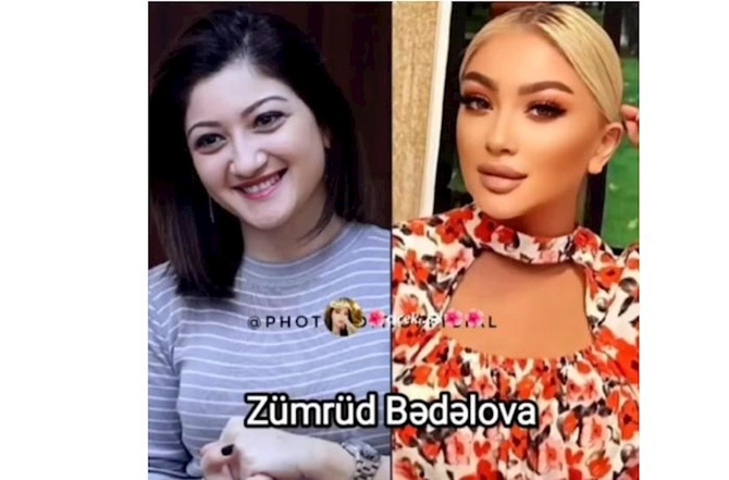 Məşhurlarımızın əməliyyatdan əvvəl və sonrakı HALLARI — FOTOLAR Məşhurlarımızın əməliyyatdan əvvəl və sonrakı HALLARI — FOTOLAR