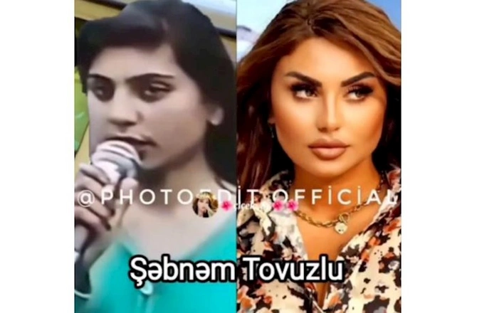 Məşhurlarımızın əməliyyatdan əvvəl və sonrakı HALLARI — FOTOLAR Məşhurlarımızın əməliyyatdan əvvəl və sonrakı HALLARI — FOTOLAR