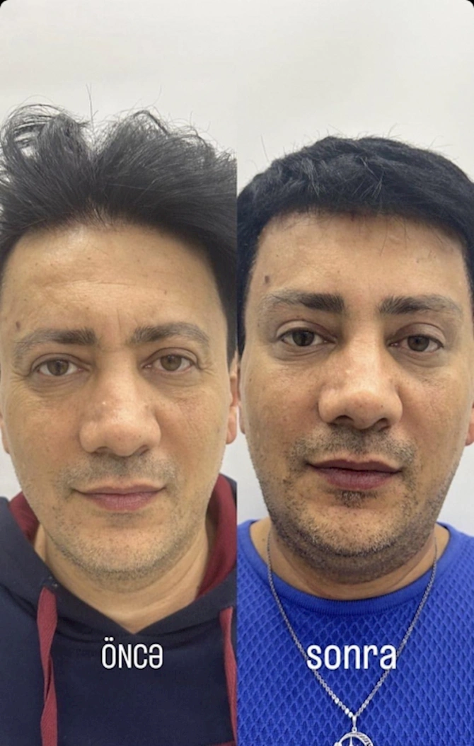 Sərxanın plastik əməliyyatdan sonrakı halı — FOTO