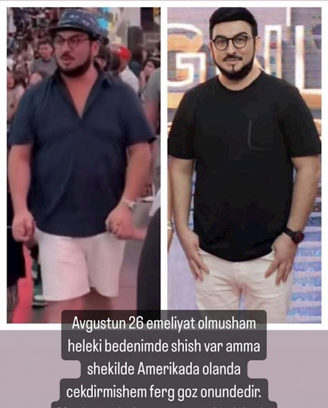 Tolik plastik əməliyyatdan sonra — FOTO