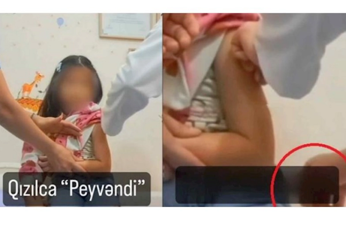 “Medera”dakı qızılca peyvəndi qalmaqalına aydınlıq gətirildi — VİDEO