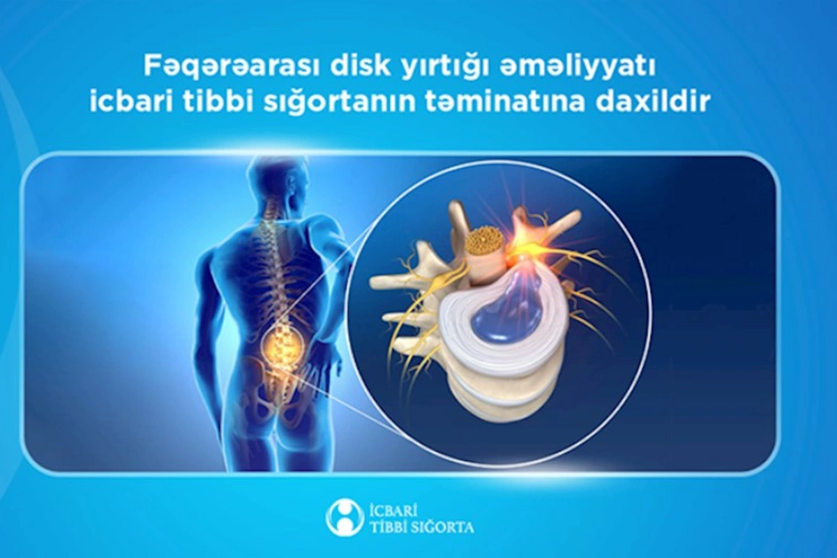 Bu əməliyyat da icbari tibbi sığortanın təminatına daxildi