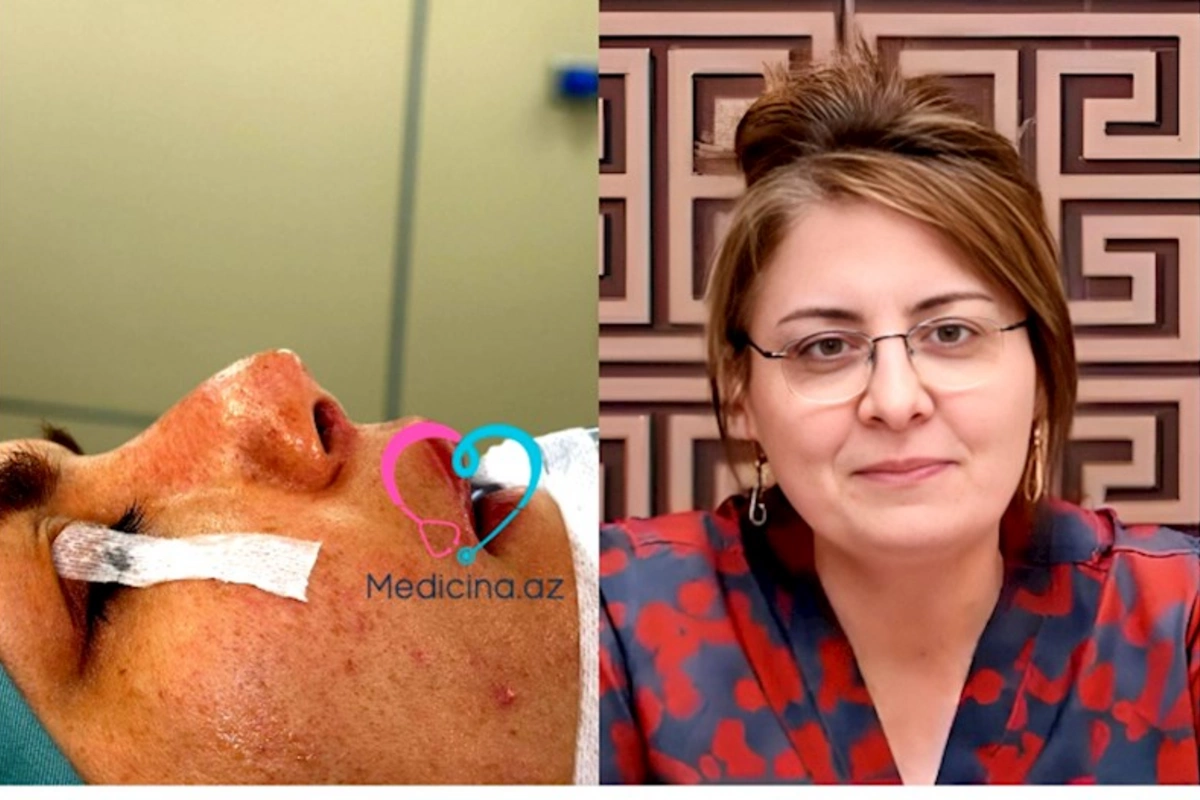 Daha bir estetik əməliyyat faciəsi — Baş həkim həmkarının burnunu tanınmaz hala saldı (FOTOLAR)