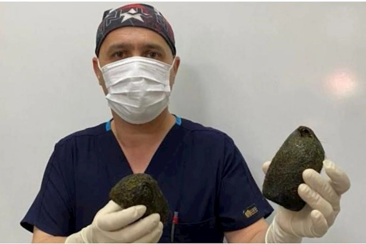 Qadının mədəsindən 2 kiloqram saç tükü çıxdı