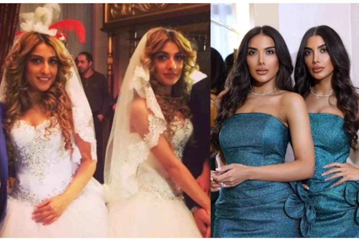 Əkizlərin plastik əməliyyatdan əvvəlki halını paylaşdı