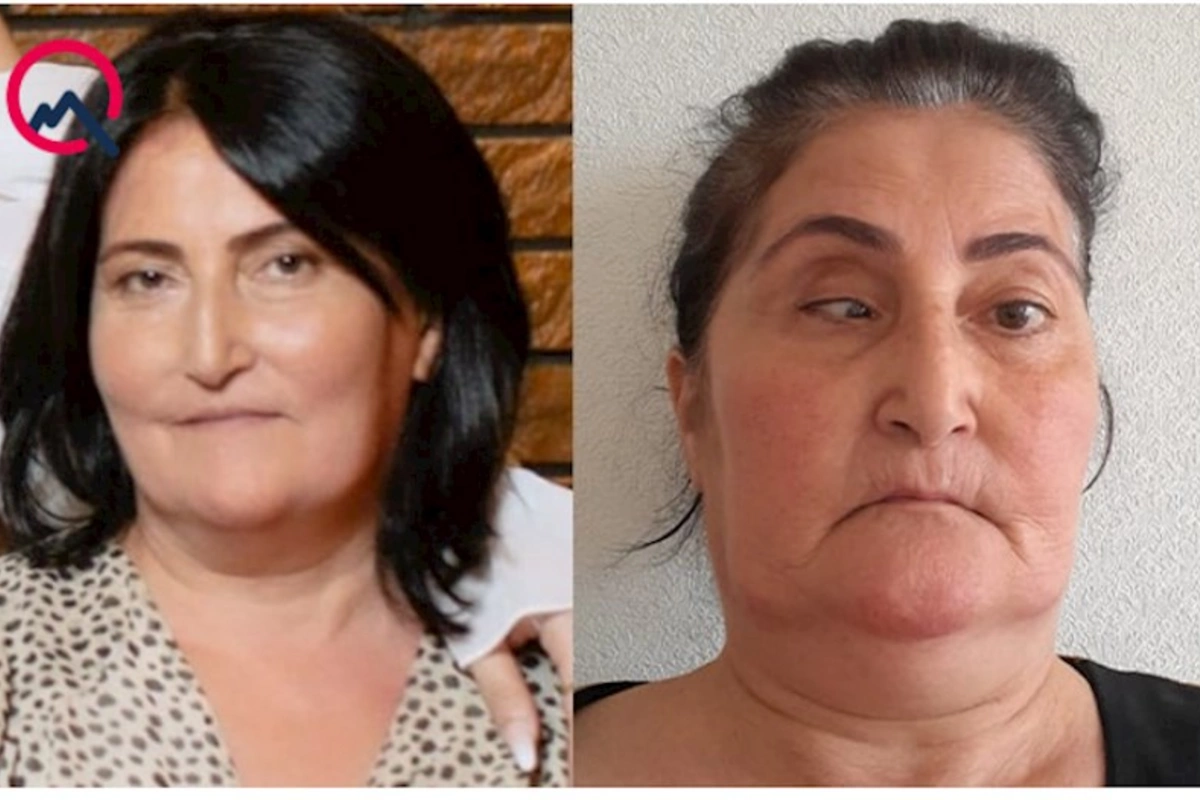 Burun əməliyyatına girən qadının gözündə çəplik yarandı — FOTOLAR