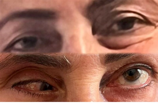 Burun əməliyyatına girən qadının gözündə çəplik yarandı — FOTOLAR