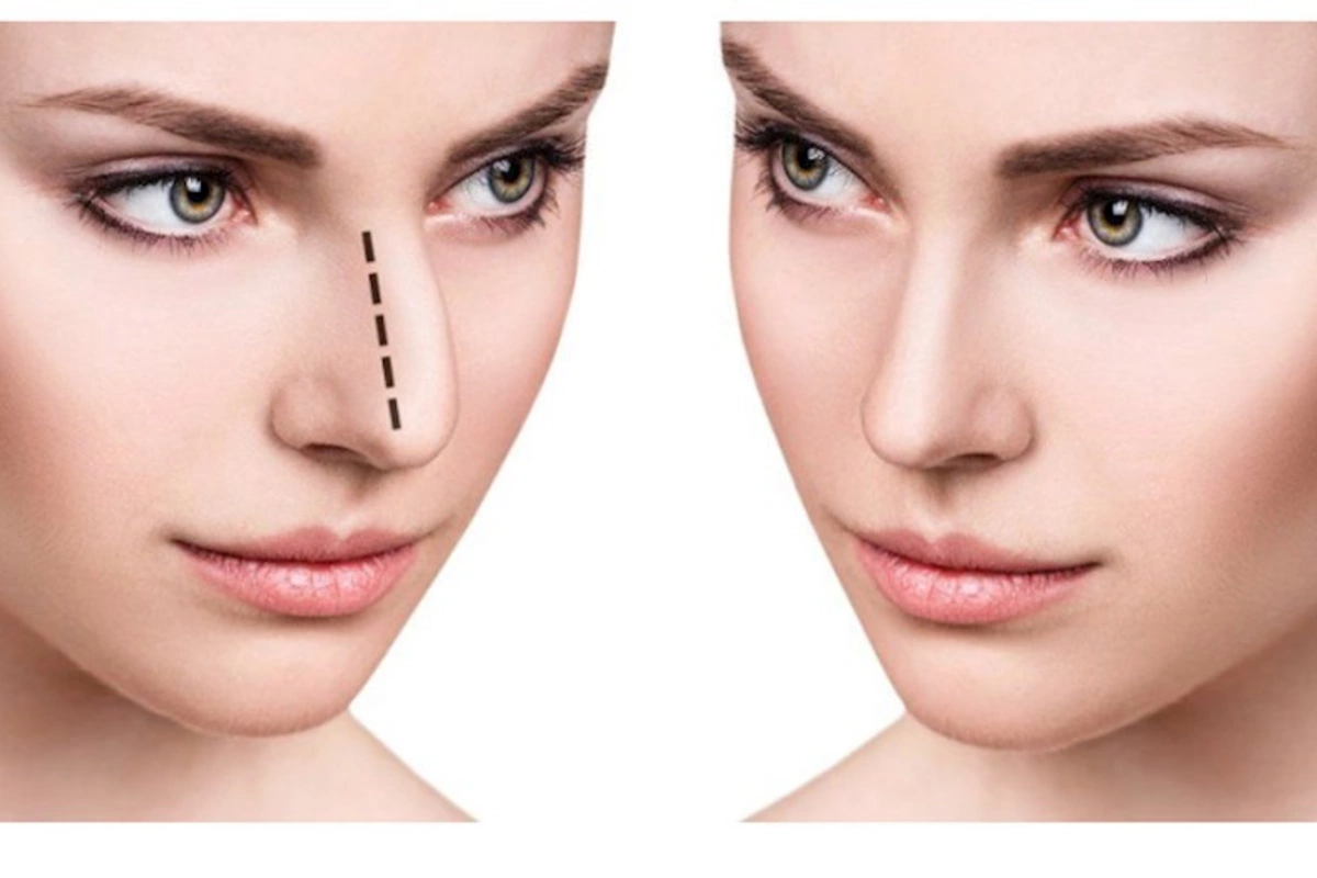Kimlərə rinoplastika əməliyyatı olmaz?