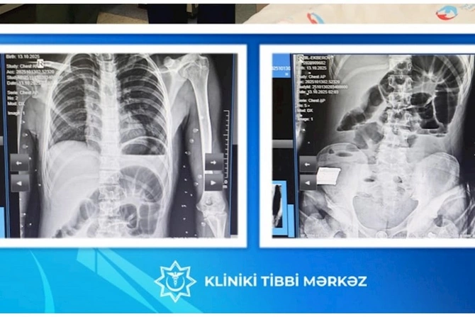 Bakıda 17 yaşlı yeniyetmənin bağırsağından taxta çıxarılıb — FOTOLAR