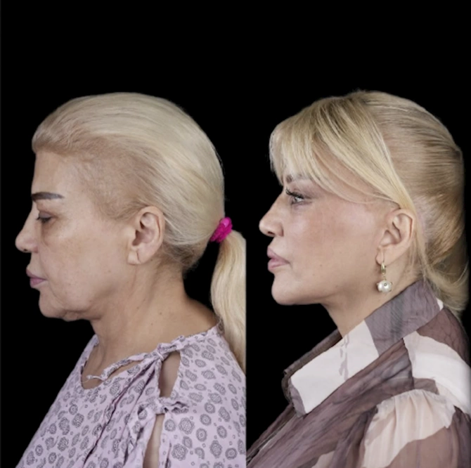 Mətanət İsgəndərli əməliyyatla belə dəyişdi — FOTOLAR