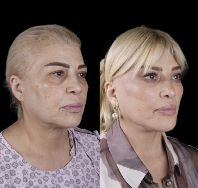 Mətanət İsgəndərli əməliyyatla belə dəyişdi — FOTOLAR
