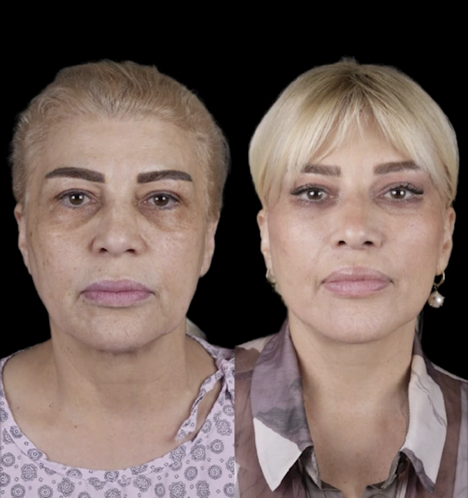 Mətanət İsgəndərli əməliyyatla belə dəyişdi — FOTOLAR