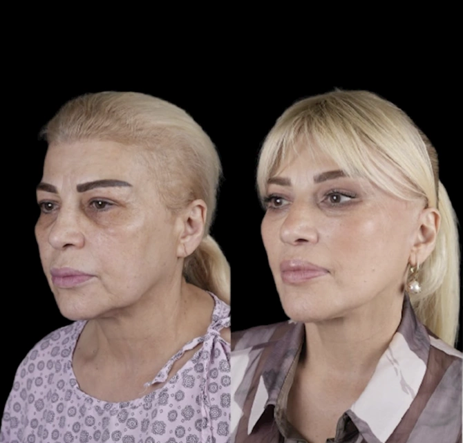 Mətanət İsgəndərli əməliyyatla belə dəyişdi — FOTOLAR