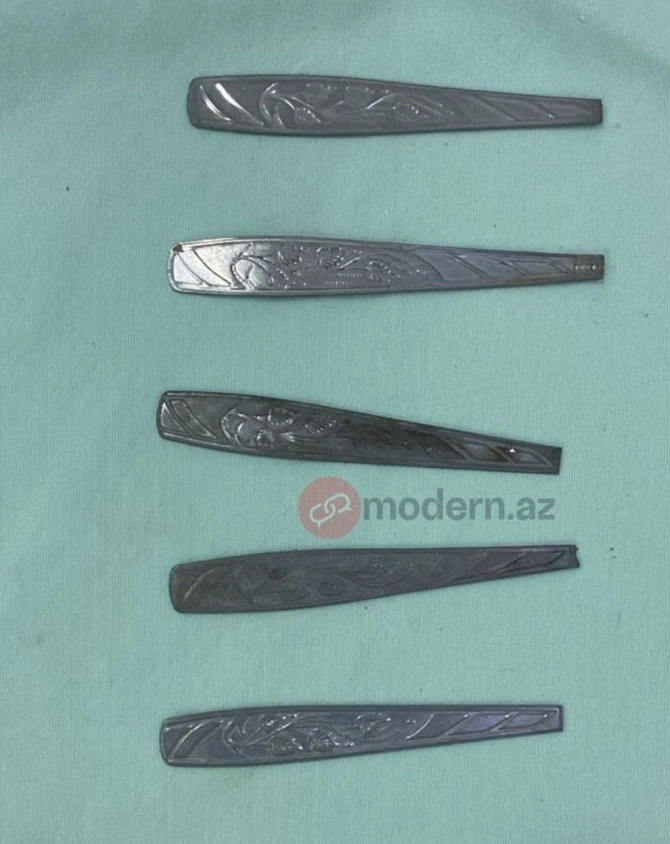 Bakı sakini 9 ədəd qaşıq uddu — FOTOLAR
