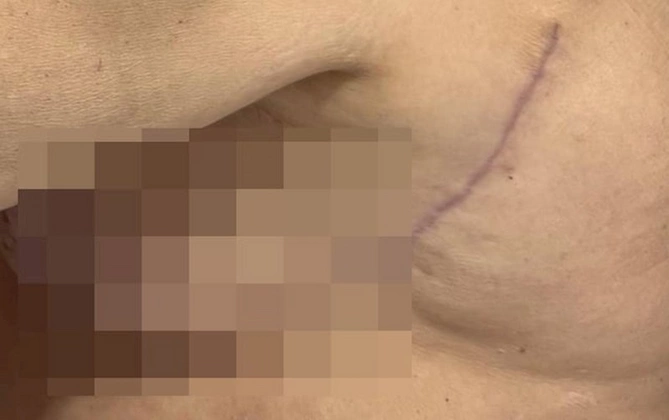 “Həkim məni 3 dəfə əməliyyat edib pis vəziyyətə qoydu” — FOTOLAR “Həkim məni 3 dəfə əməliyyat edib pis vəziyyətə qoydu” — FOTOLAR