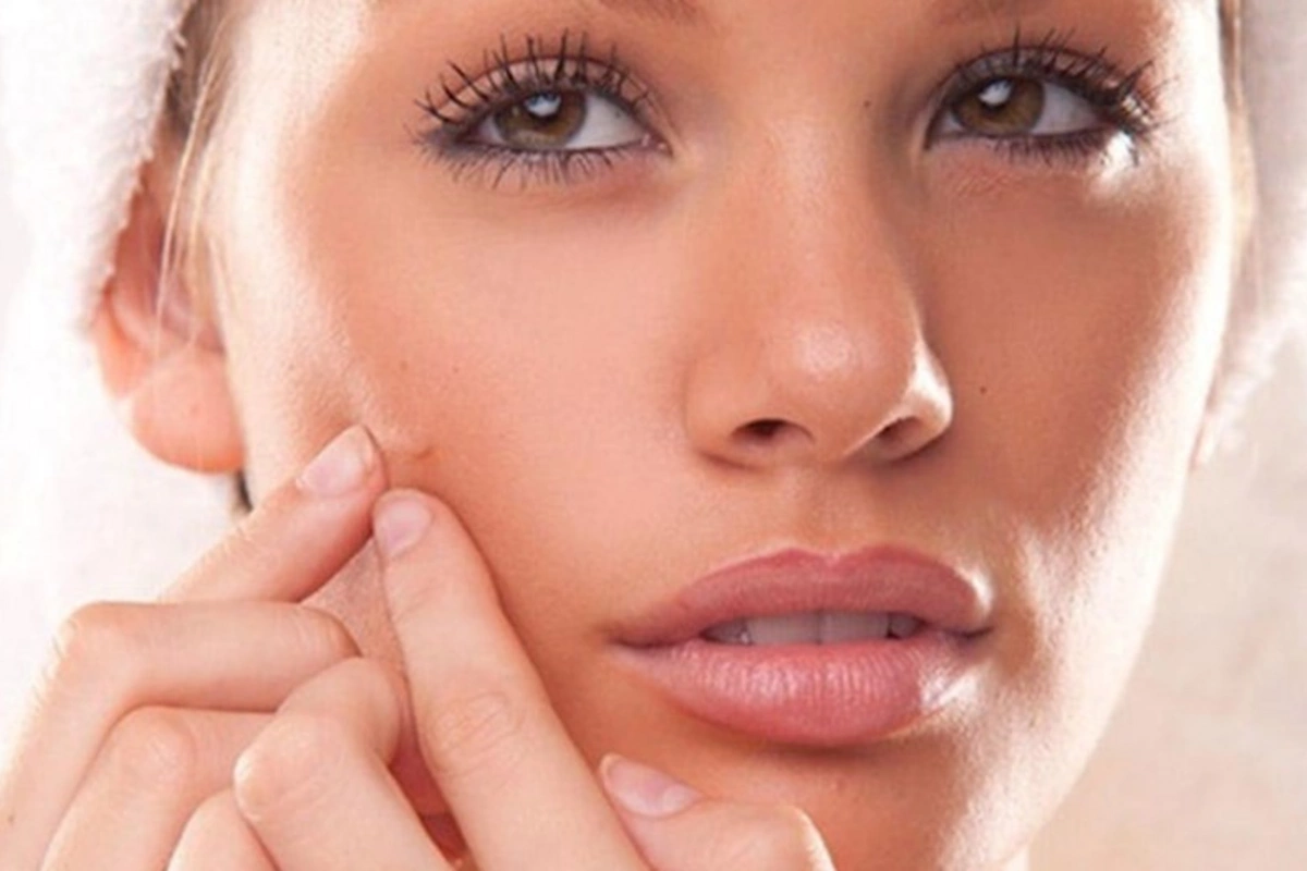 Bu qidalar üzdə sızanaq yaradır — Dermatoloqlardan xəbərdarlıq