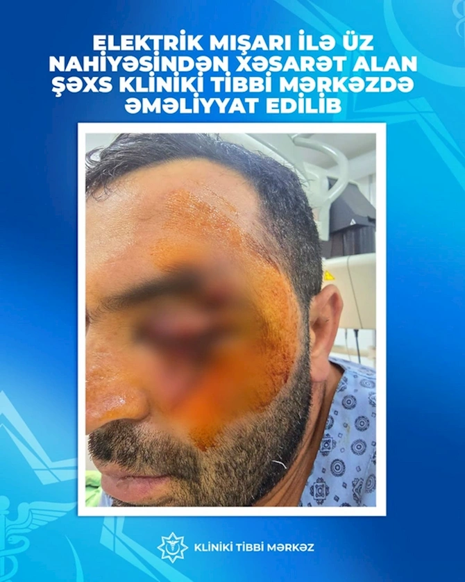 Bakıda DƏHŞƏT: Laqonda kişinin üzünü kəsdi — FOTO