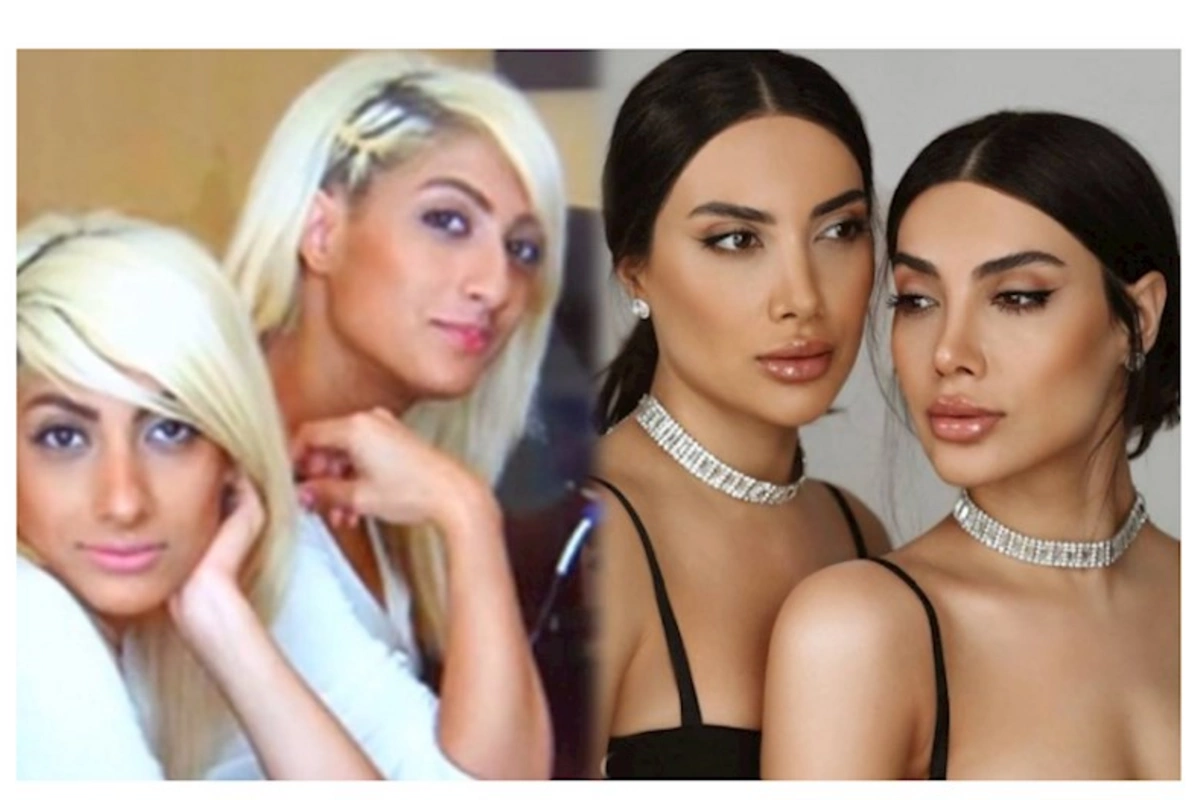 Sevil və Sevincin plastik əməliyyatdan əvvəlki halı — VİDEO