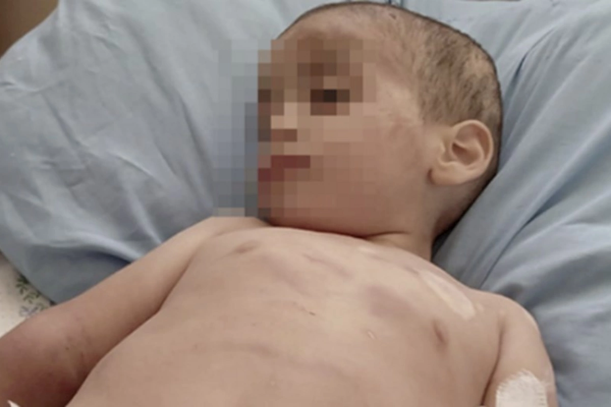 Döyülən azyaşlının vəziyyəti hələ də ağırdır