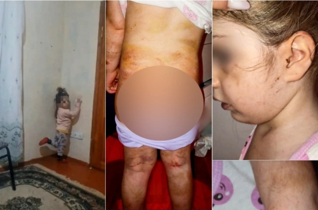 Bakıda ananın azyaşlı qızına verdiyi işgəncələr: Bədəni yandırılıb, kəmərlə döyülüb — TƏFƏRRÜAT