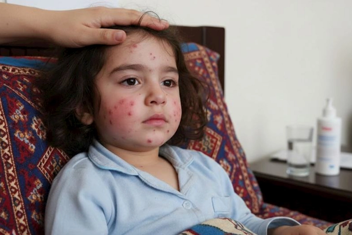 Uşaqlar arasında virus yayılıb — Həkimdən valideynlərə müraciət