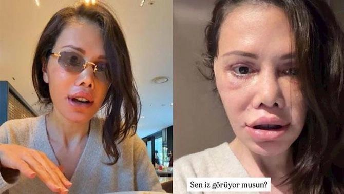 Survivorun iştirakçısı əməliyyatla üzünü dəyişdirdi — FOTO Survivorun iştirakçısı əməliyyatla üzünü dəyişdirdi — FOTO