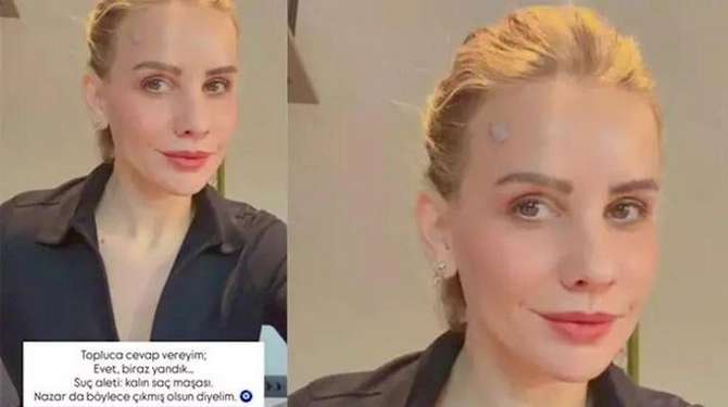Esra Erolun üzü yandı — FOTO