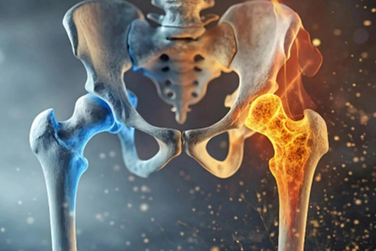 Osteoporoz ən çox hansı sümüklərə zərər verir? — Mütəxəssis açıqladı