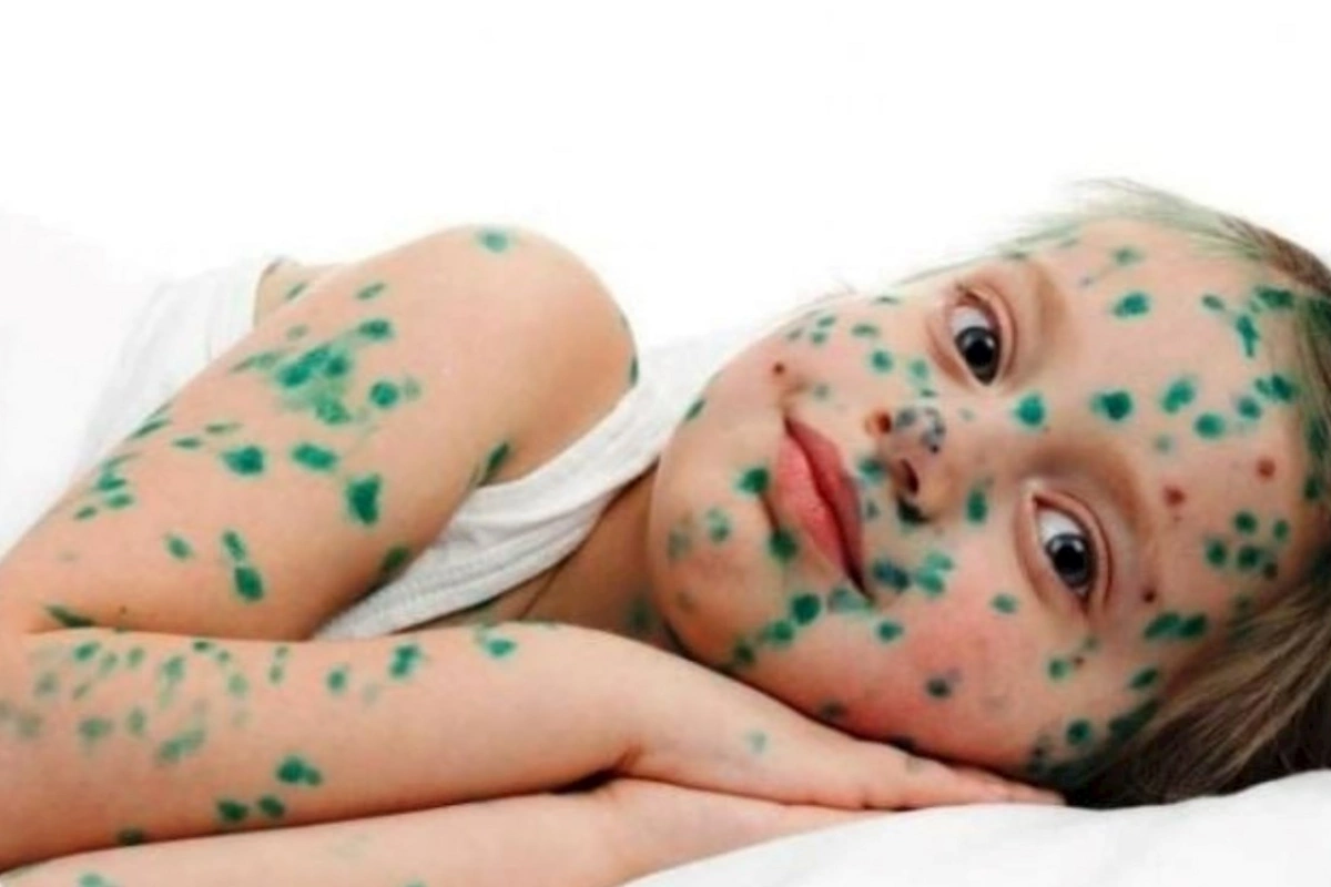 Su çiçəyi yenidən yayılır — Pediatrdan xəbərdarlıq