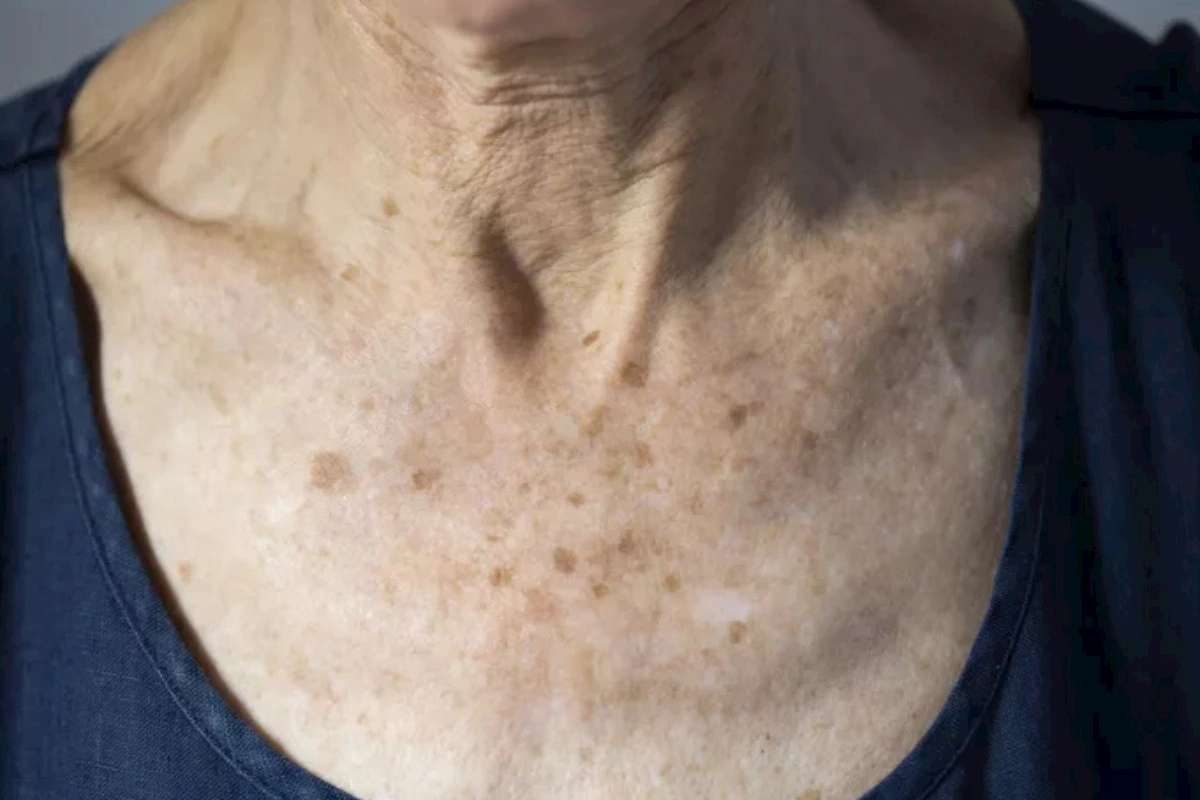 Günəş ləkəsidir, yoxsa dəri xərçəngi? — Bu əlamətlər varsa, dərhal dermatoloqa qaçın