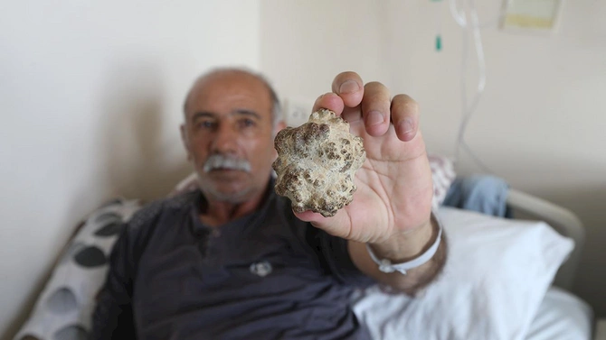Böyrəyindən alma boyda daş çıxarıldı — FOTO