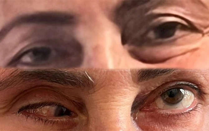 Bu klinika təzminat ödəyəcək — Burun düzəldəndə gözü zədələyib (FOTOLAR)