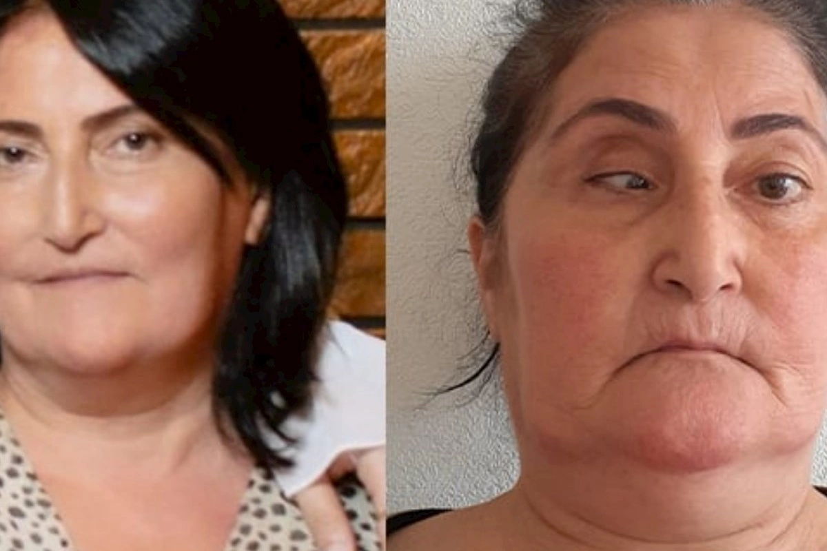 Bu klinika təzminat ödəyəcək — Burun düzəldəndə gözü zədələyib (FOTOLAR)
