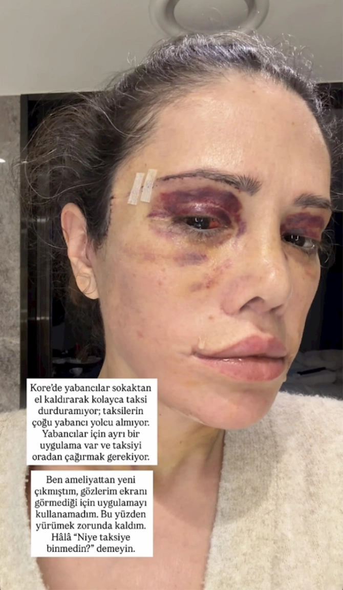 Estetik əməliyyatı uğursuz oldu, üz rekonstruksiyası etdirdi Estetik əməliyyatı uğursuz oldu, üz rekonstruksiyası etdirdi