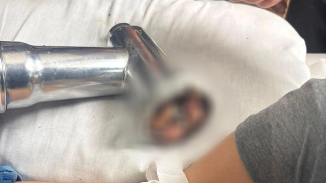 Həkimlər 3 yaşlı uşağın əlini xilas etdi — FOTOLAR